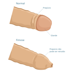 Nesta ilustração, um pênis situado acima na imagem remonta um caso normal do prepúcio, enquanto a figura abaixo demonstra um caso típico de fimose.